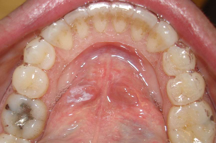 White Lump On Floor Of Mouth